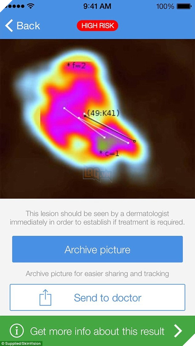 Ung dung dien thoai giup phat hien ung thu da qua not ruoi hinh anh 1