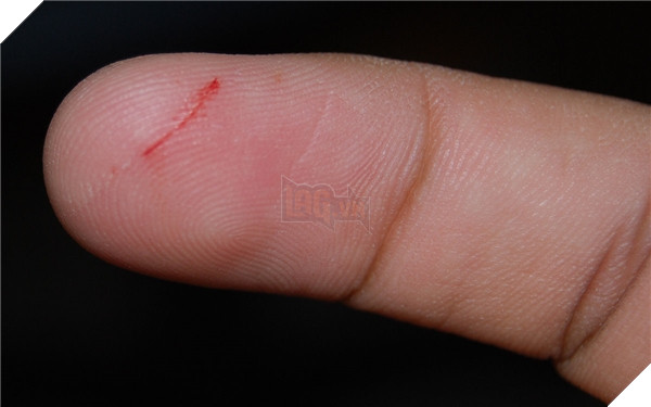 Cần biết rõ vết thương nặng đến mức nào, liệu có máu chảy và người bị nạn có bị nhiễm trùng hay không.