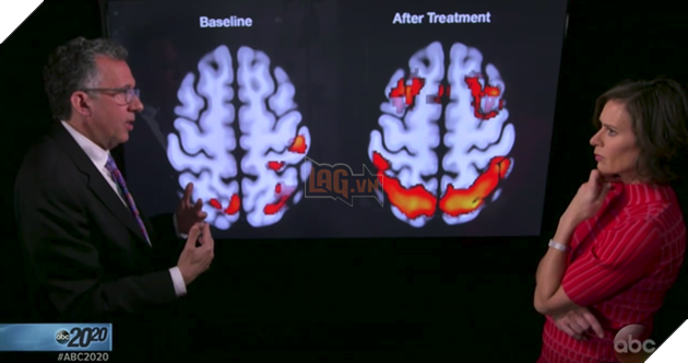 
Ảnh chụp điện não đồ của Josh sau 2 tháng điều trị với sự hồi phục của các hành vi tự nhiên
