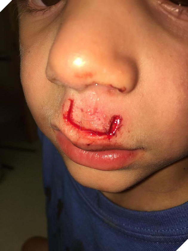 Món đồ chơi Fidget Spinner phát nổ làm một cậu bé phải khâu 30 mũi, tại sao vậy?