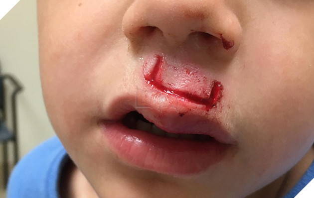 Món đồ chơi Fidget Spinner phát nổ làm một cậu bé phải khâu 30 mũi, tại sao vậy?