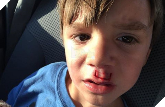 Món đồ chơi Fidget Spinner phát nổ làm một cậu bé phải khâu 30 mũi, tại sao vậy?