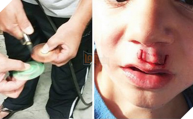 Món đồ chơi Fidget Spinner phát nổ làm một cậu bé phải khâu 30 mũi, tại sao vậy?