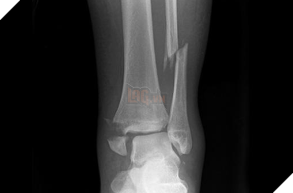 Thanh niên bị gãy cổ chân vì cố gắng tập luyện như Saitama 3