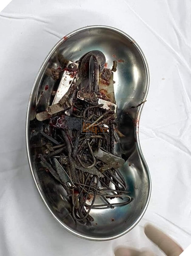  Chuyện kinh dị có thật Phẫu thuật lấy ra hơn 1kg sắt trong bụng một thanh niên ở Bình Dương 2