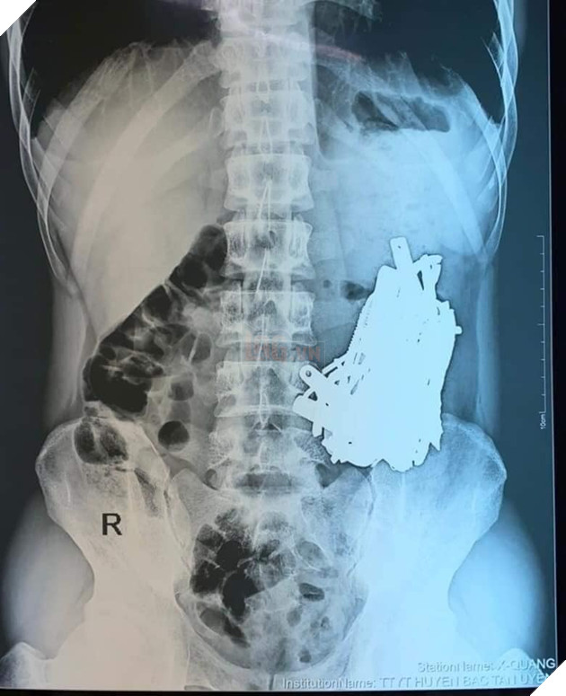  Chuyện kinh dị có thật Phẫu thuật lấy ra hơn 1kg sắt trong bụng một thanh niên ở Bình Dương 3