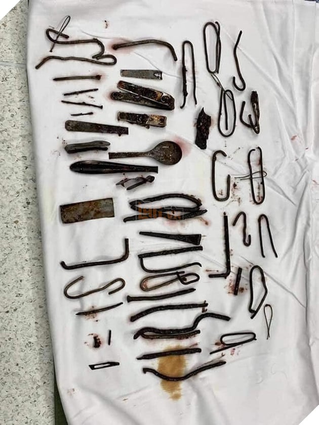  Chuyện kinh dị có thật Phẫu thuật lấy ra hơn 1kg sắt trong bụng một thanh niên ở Bình Dương