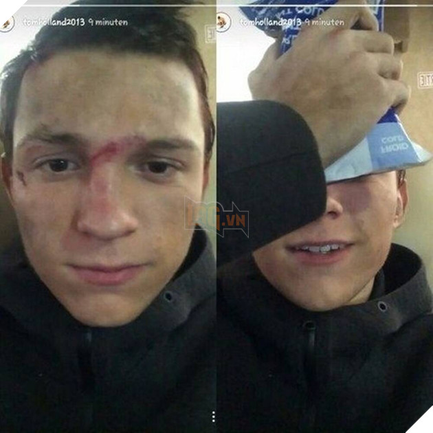 Tom Holland bất ngờ gặp chấn thương khi đang ghi hình phim mới