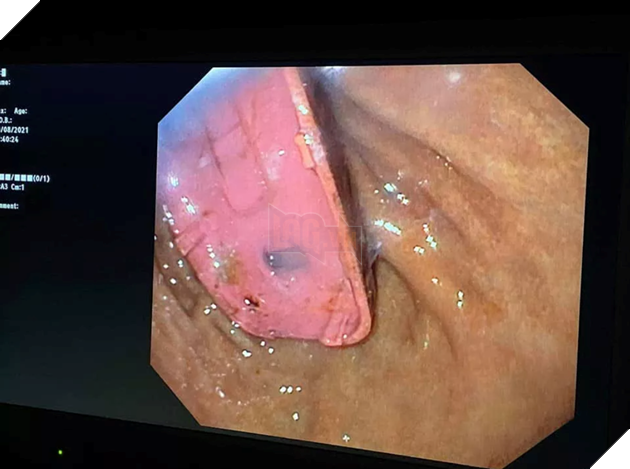 Một người đàn ông yêu cầu phẫu thuật sau khi nuốt nhầm chiếc điện thoại di động 4
