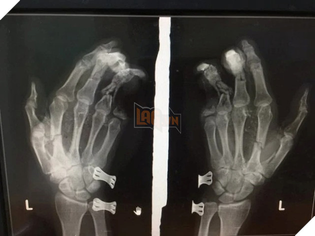 Từng được cảnh báo rất nhiều nhưng những tai nạn do vừa dùng điện thoại vừa sạc vẫn diễn ra 2