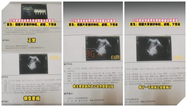 Chỉ vì thức khuya chơi game mà nam game thủ mắc phải căn bệnh nặng, phải tiến hành lọc máu khẩn cấp