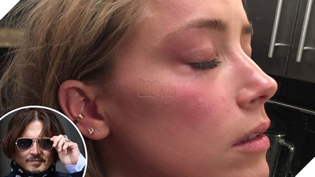 amber heard johnny depp, amber heard bị đánh