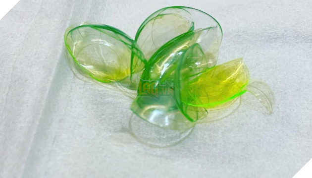 Kinh hãi với người phụ nữ bỏ quên 23 kính áp tròng trong mắt nhiều năm trời  2