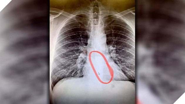 Hi hữu chiếc AirPods bị một cô nàng nuốt vào bụng và vẫn hoạt động tốt sau 9 giờ năm trong dạ dày